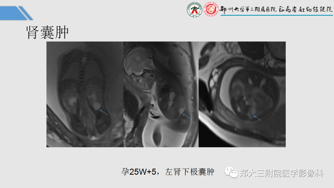 影像PPT - 【PPT】胎儿泌尿生殖系统常见疾病的MRI诊断-29