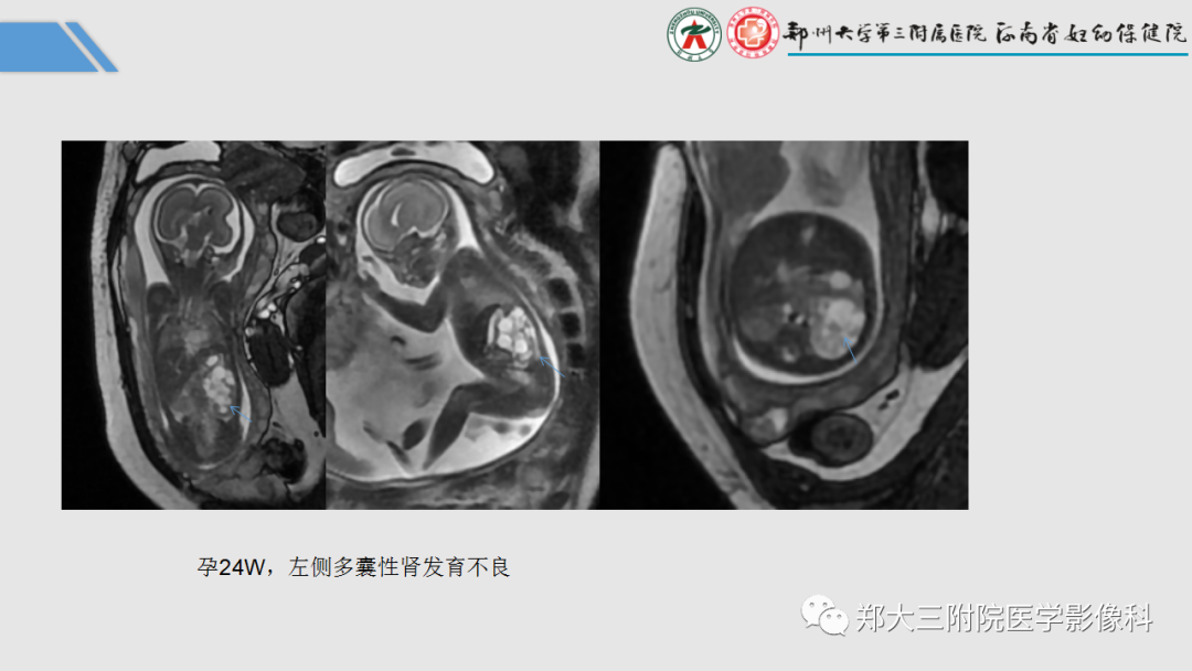 影像PPT - 【PPT】胎儿泌尿生殖系统常见疾病的MRI诊断-31