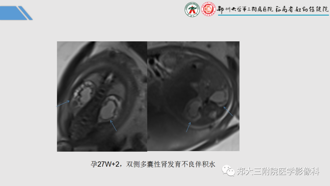 影像PPT - 【PPT】胎儿泌尿生殖系统常见疾病的MRI诊断-32