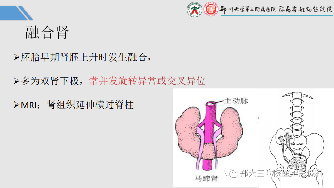 影像PPT - 【PPT】胎儿泌尿生殖系统常见疾病的MRI诊断-25