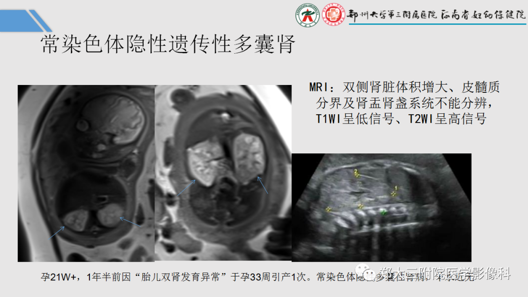 影像PPT - 【PPT】胎儿泌尿生殖系统常见疾病的MRI诊断-34