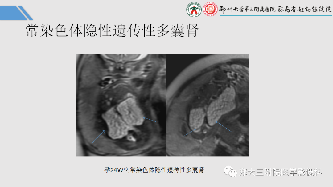 影像PPT - 【PPT】胎儿泌尿生殖系统常见疾病的MRI诊断-35