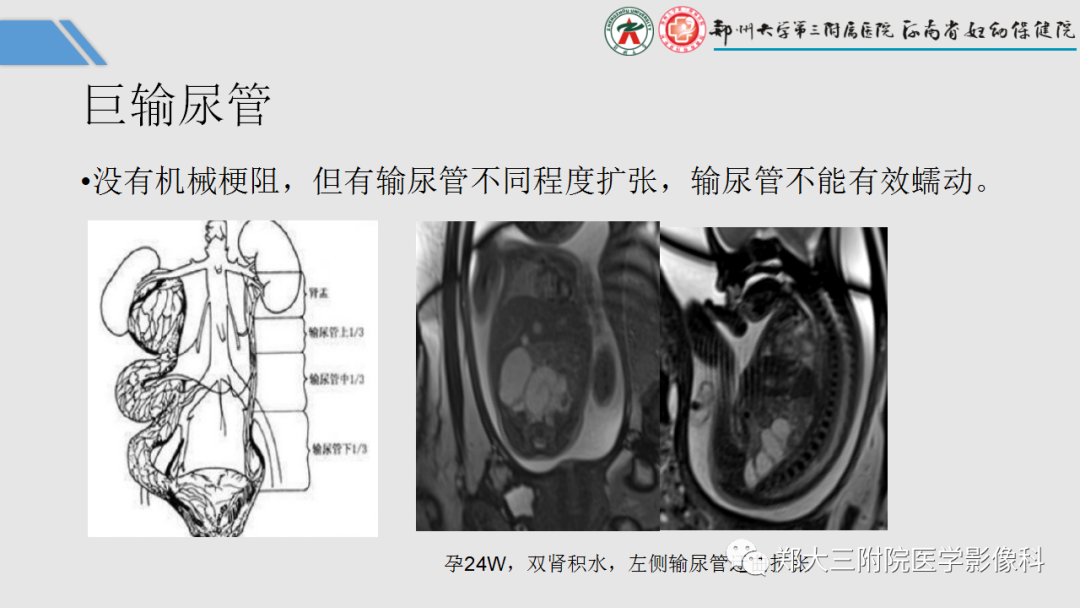 影像PPT - 【PPT】胎儿泌尿生殖系统常见疾病的MRI诊断-39