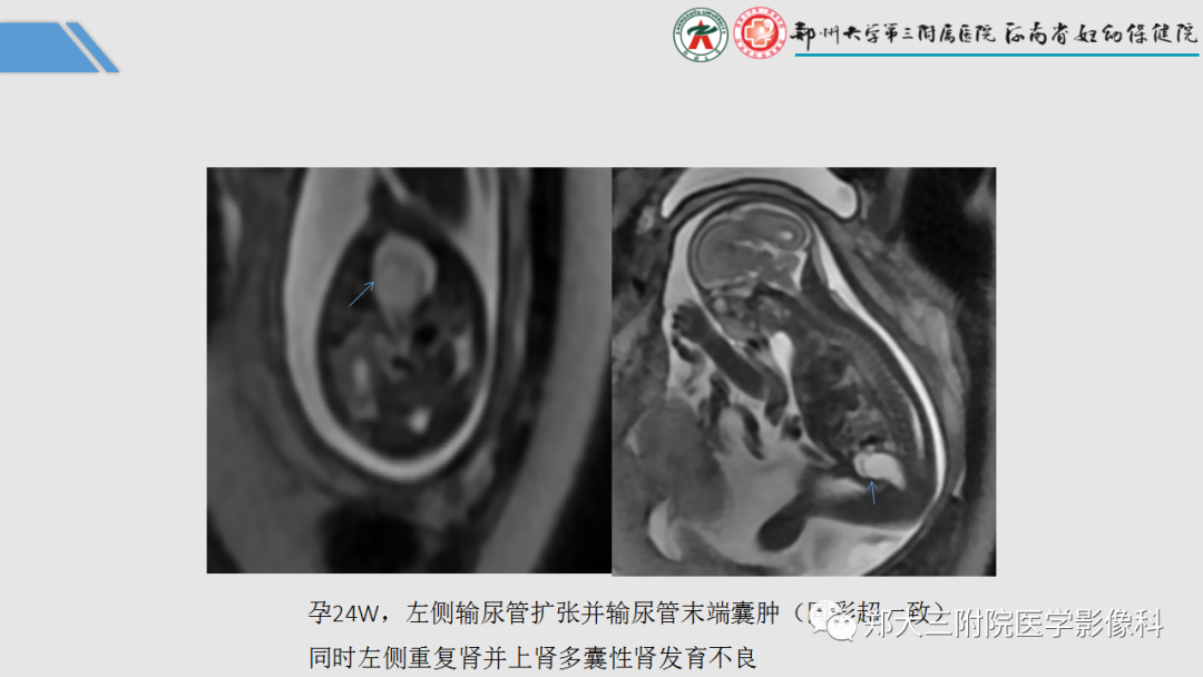 影像PPT - 【PPT】胎儿泌尿生殖系统常见疾病的MRI诊断-41