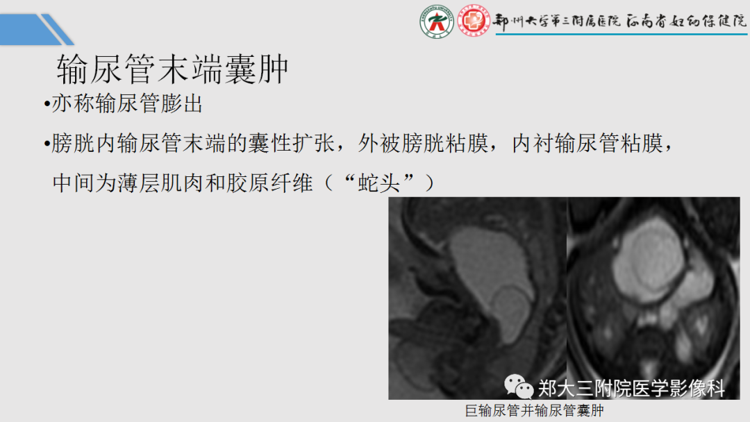 影像PPT - 【PPT】胎儿泌尿生殖系统常见疾病的MRI诊断-40