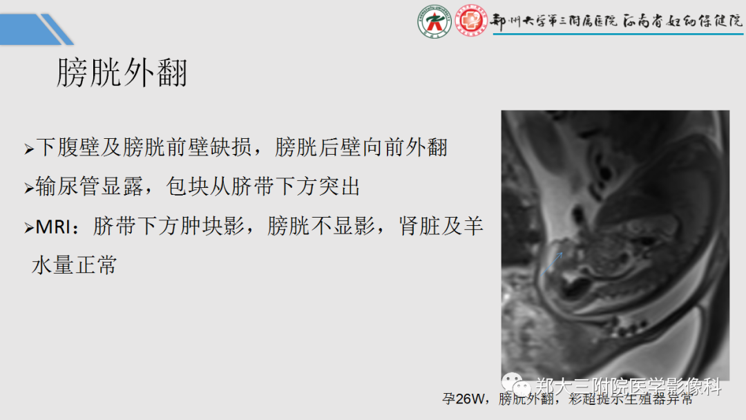 影像PPT - 【PPT】胎儿泌尿生殖系统常见疾病的MRI诊断-43