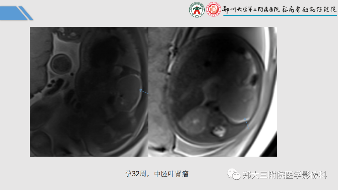 影像PPT - 【PPT】胎儿泌尿生殖系统常见疾病的MRI诊断-45