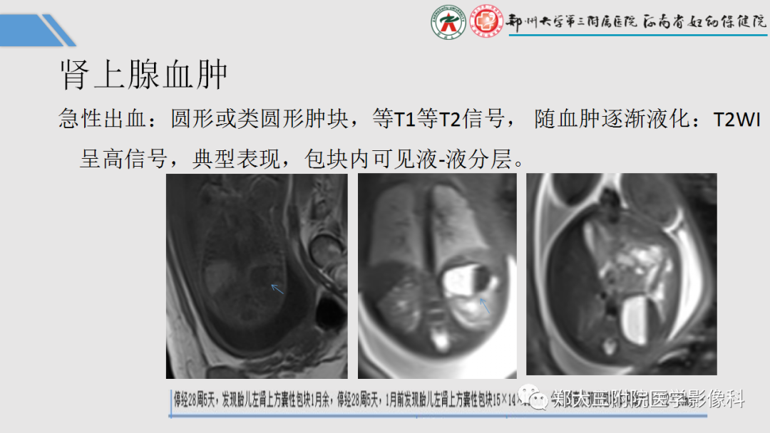 影像PPT - 【PPT】胎儿泌尿生殖系统常见疾病的MRI诊断-47