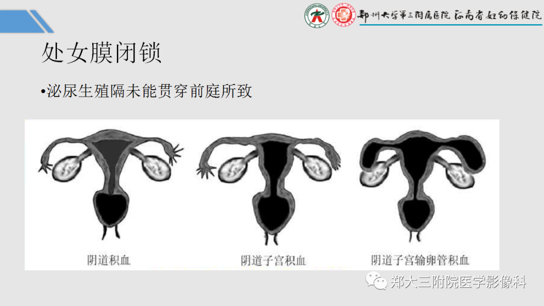 影像PPT - 【PPT】胎儿泌尿生殖系统常见疾病的MRI诊断-49