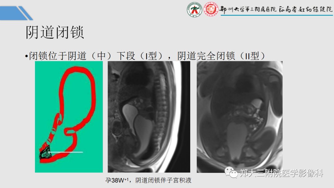 影像PPT - 【PPT】胎儿泌尿生殖系统常见疾病的MRI诊断-52