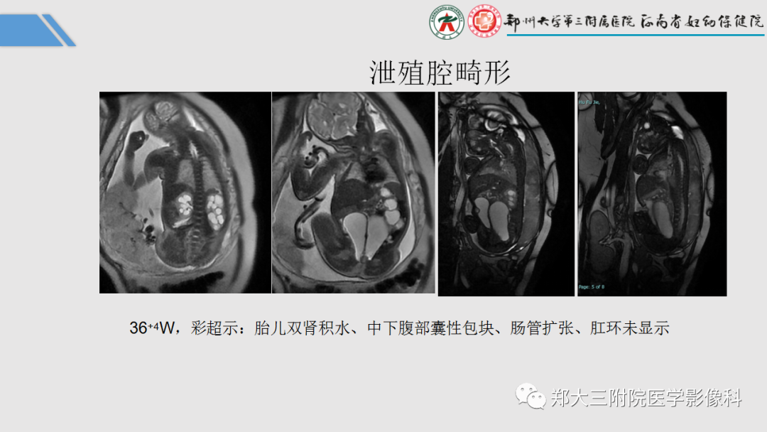 影像PPT - 【PPT】胎儿泌尿生殖系统常见疾病的MRI诊断-53