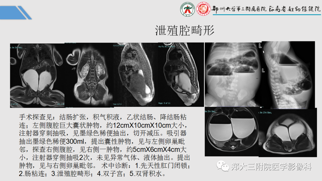 影像PPT - 【PPT】胎儿泌尿生殖系统常见疾病的MRI诊断-54