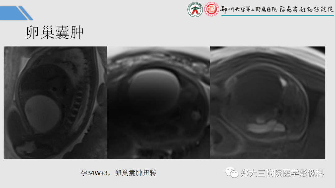 影像PPT - 【PPT】胎儿泌尿生殖系统常见疾病的MRI诊断-55