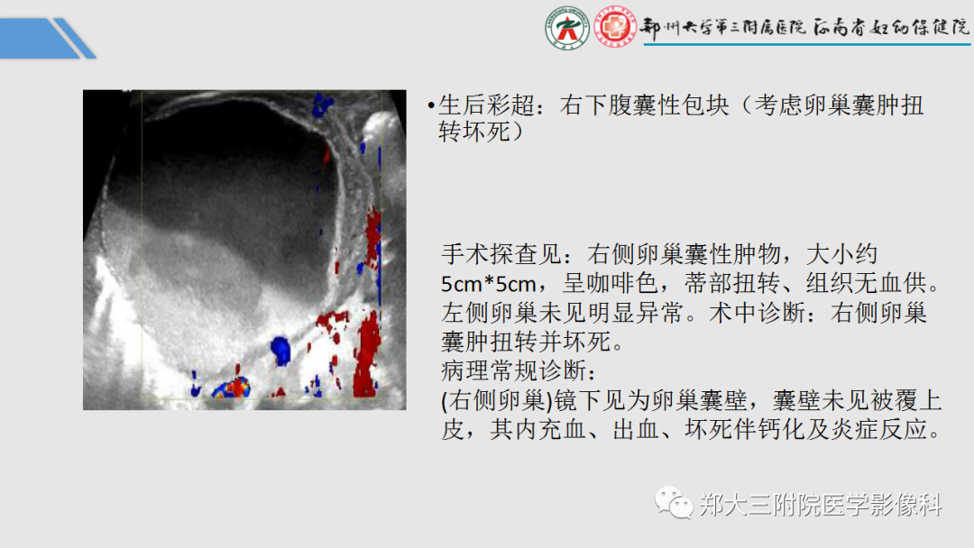影像PPT - 【PPT】胎儿泌尿生殖系统常见疾病的MRI诊断-56