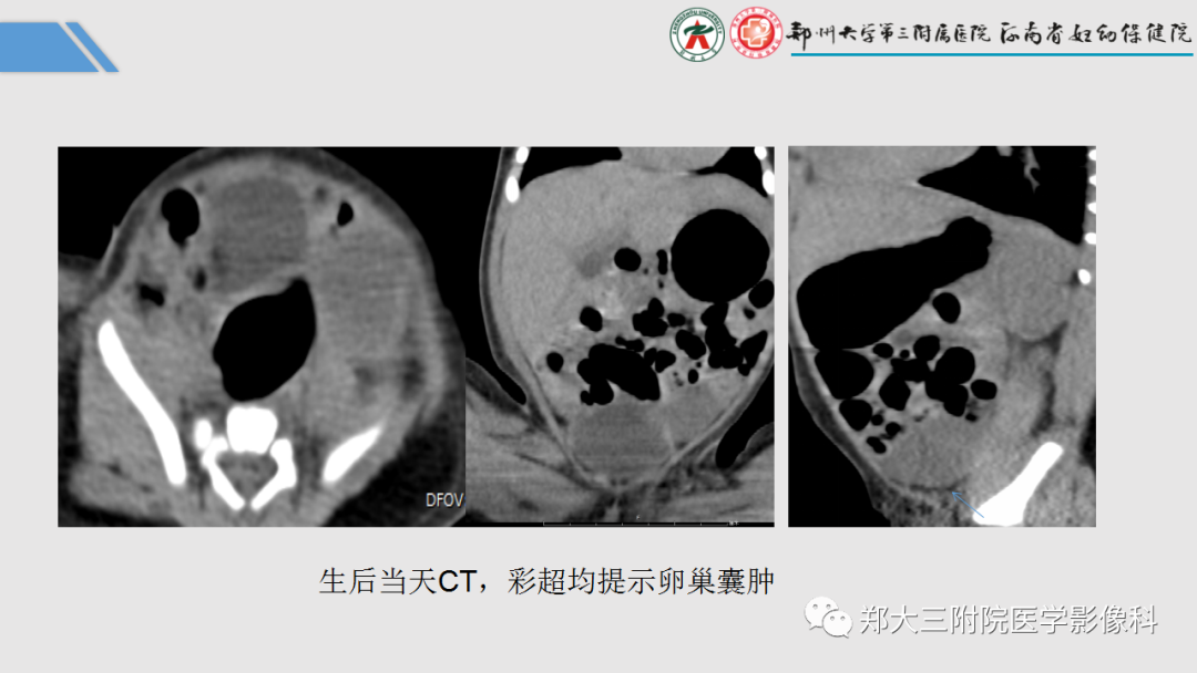 影像PPT - 【PPT】胎儿泌尿生殖系统常见疾病的MRI诊断-58