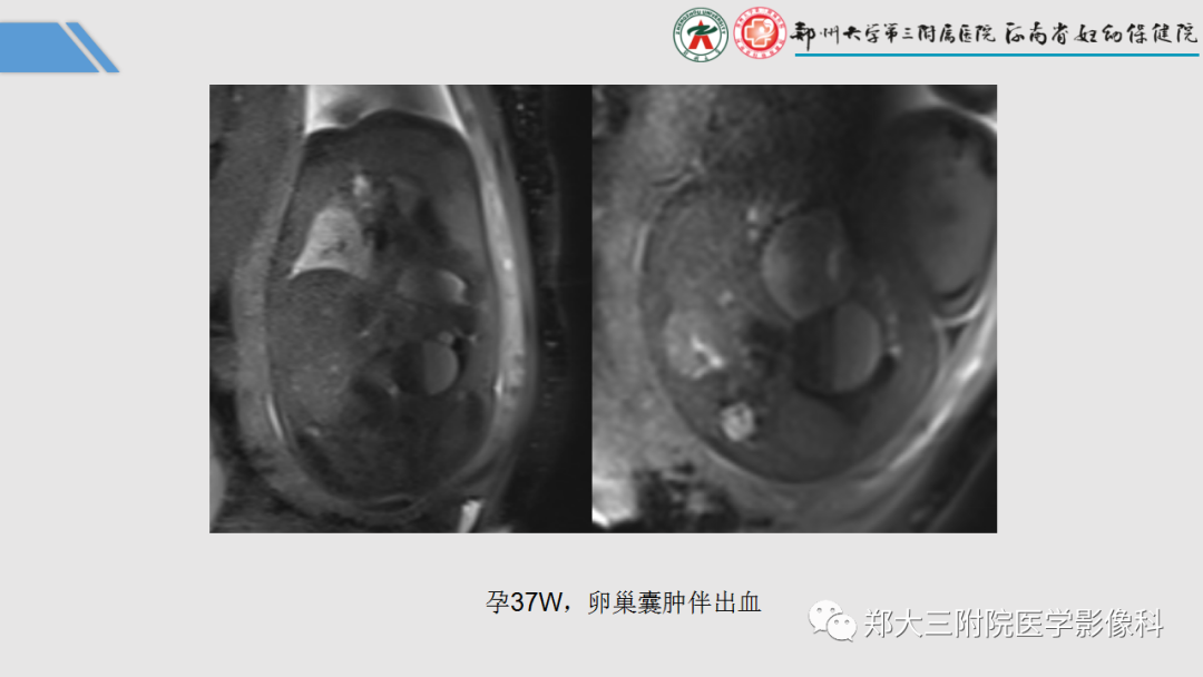 影像PPT - 【PPT】胎儿泌尿生殖系统常见疾病的MRI诊断-57