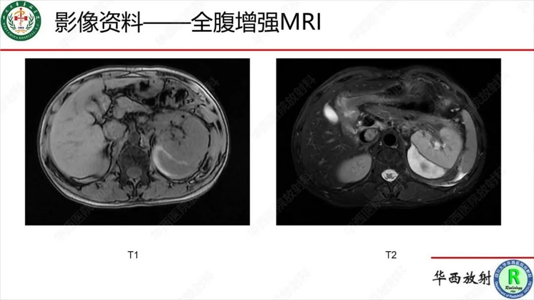 影像PPT - 【病例】肾脏滑膜肉瘤1例MR影像-4