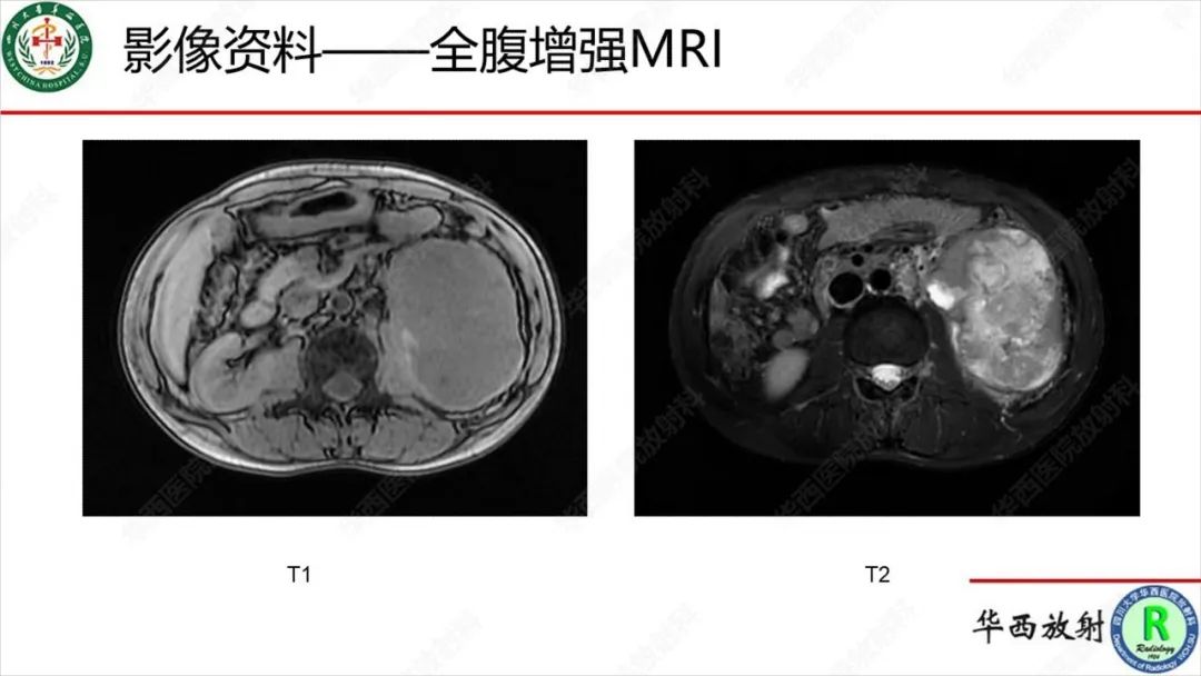 影像PPT - 【病例】肾脏滑膜肉瘤1例MR影像-5