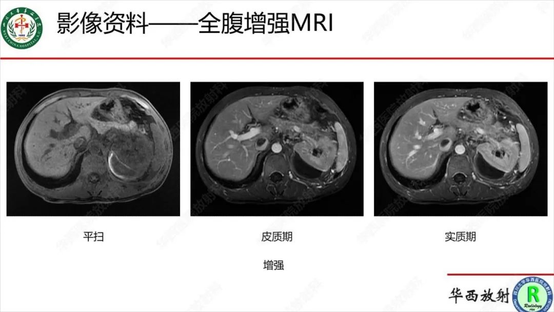 影像PPT - 【病例】肾脏滑膜肉瘤1例MR影像-6