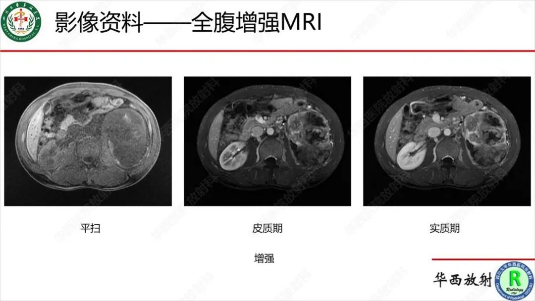 影像PPT - 【病例】肾脏滑膜肉瘤1例MR影像-7
