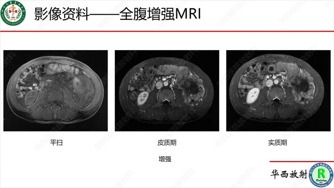 影像PPT - 【病例】肾脏滑膜肉瘤1例MR影像-8