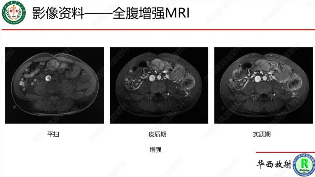 影像PPT - 【病例】肾脏滑膜肉瘤1例MR影像-9