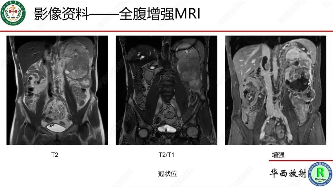 影像PPT - 【病例】肾脏滑膜肉瘤1例MR影像-10