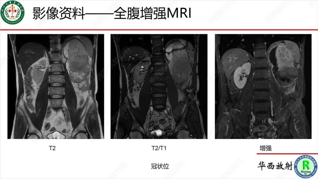 影像PPT - 【病例】肾脏滑膜肉瘤1例MR影像-11