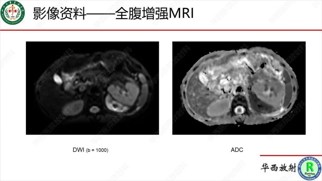 影像PPT - 【病例】肾脏滑膜肉瘤1例MR影像-12