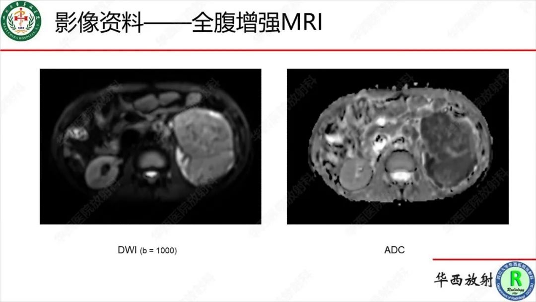 影像PPT - 【病例】肾脏滑膜肉瘤1例MR影像-13