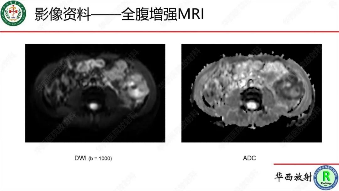影像PPT - 【病例】肾脏滑膜肉瘤1例MR影像-14