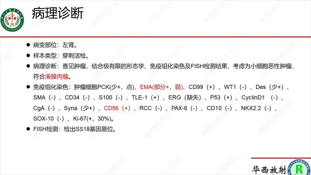 影像PPT - 【病例】肾脏滑膜肉瘤1例MR影像-16