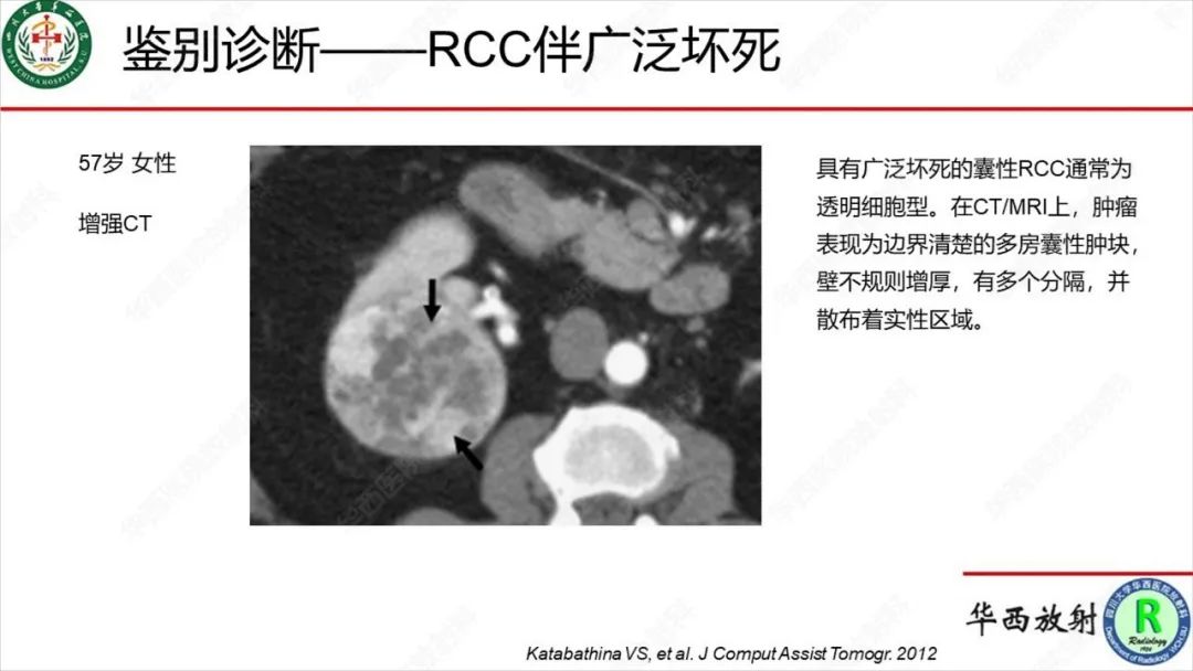 影像PPT - 【病例】肾脏滑膜肉瘤1例MR影像-25