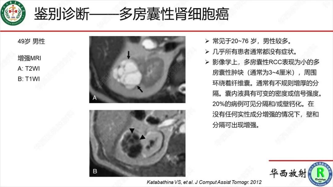 影像PPT - 【病例】肾脏滑膜肉瘤1例MR影像-23