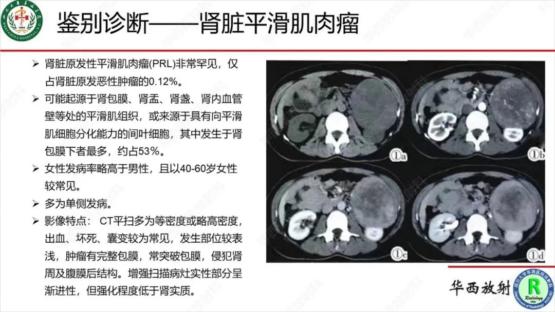 影像PPT - 【病例】肾脏滑膜肉瘤1例MR影像-27