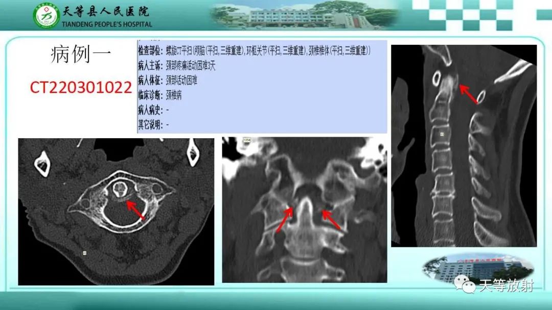 影像PPT - 【PPT】齿状突加冠综合征-6