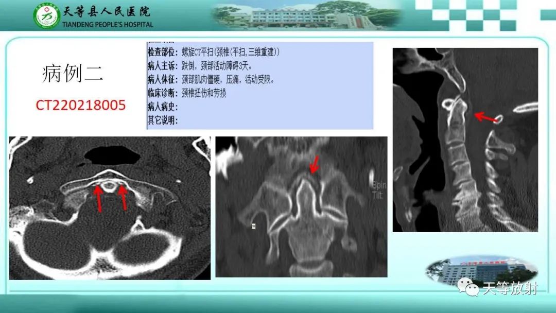 影像PPT - 【PPT】齿状突加冠综合征-7
