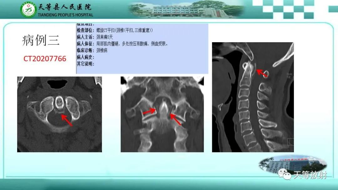 影像PPT - 【PPT】齿状突加冠综合征-8