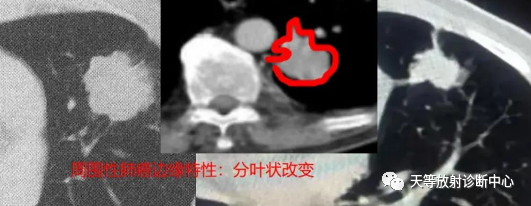 影像PPT - 肺放线菌病-14 影像PPT - 肺放线菌病-14