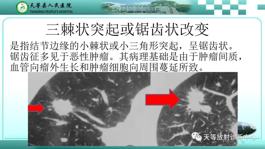 影像PPT - 肺放线菌病-15 影像PPT - 肺放线菌病-15