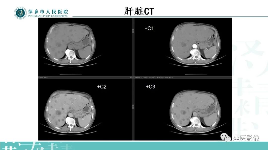 影像PPT - 【PPT】寻根问底—肝转移瘤-7