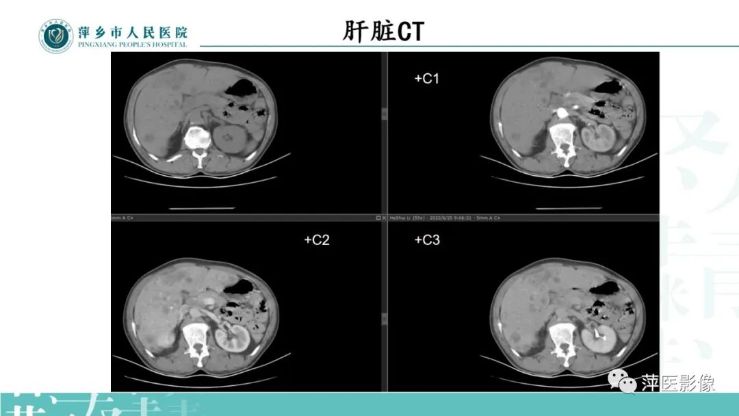 影像PPT - 【PPT】寻根问底—肝转移瘤-8