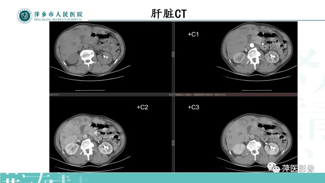 影像PPT - 【PPT】寻根问底—肝转移瘤-9