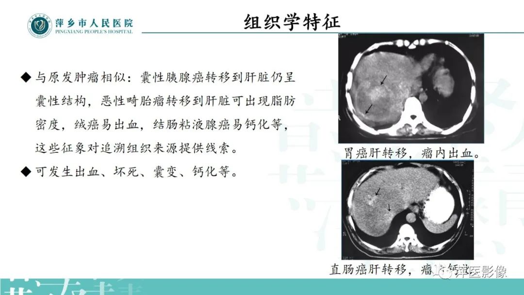 影像PPT - 【PPT】寻根问底—肝转移瘤-15