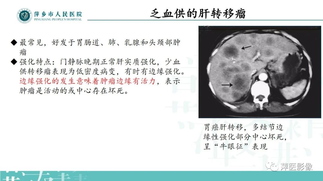 影像PPT - 【PPT】寻根问底—肝转移瘤-16