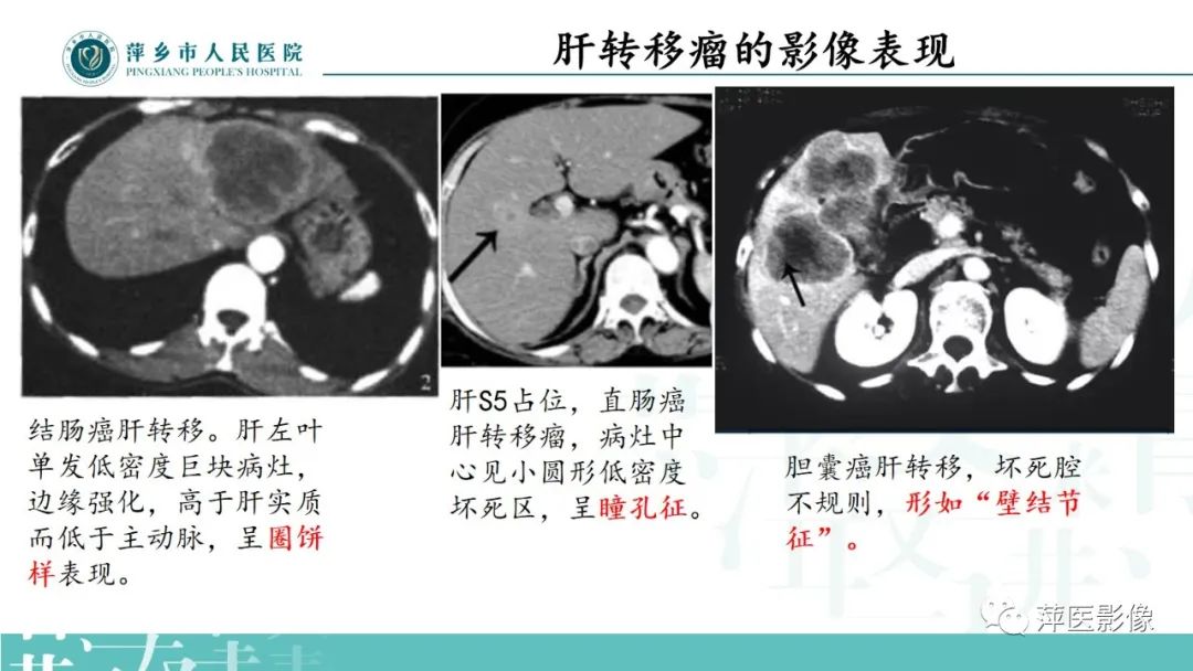 影像PPT - 【PPT】寻根问底—肝转移瘤-20