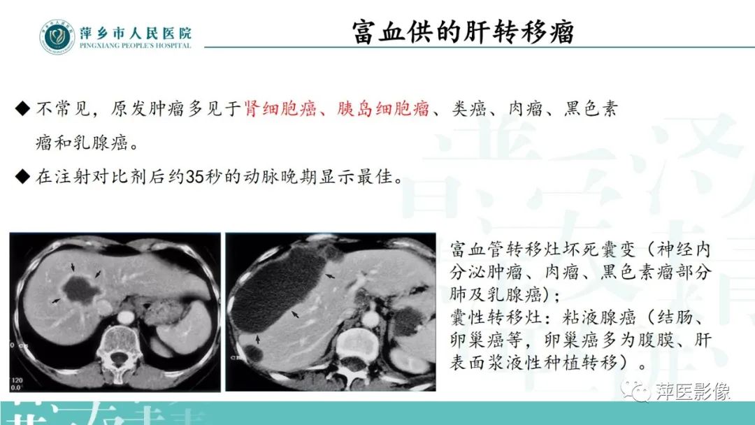 影像PPT - 【PPT】寻根问底—肝转移瘤-17