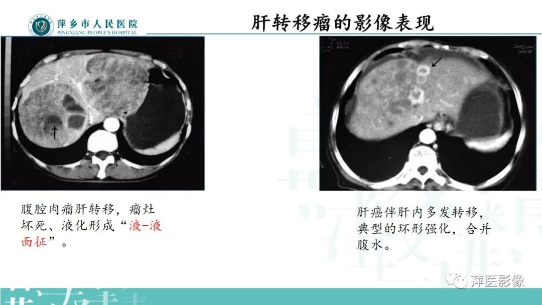 影像PPT - 【PPT】寻根问底—肝转移瘤-22