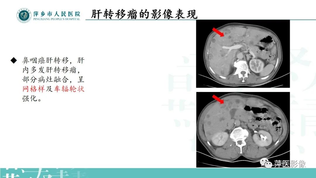 影像PPT - 【PPT】寻根问底—肝转移瘤-25