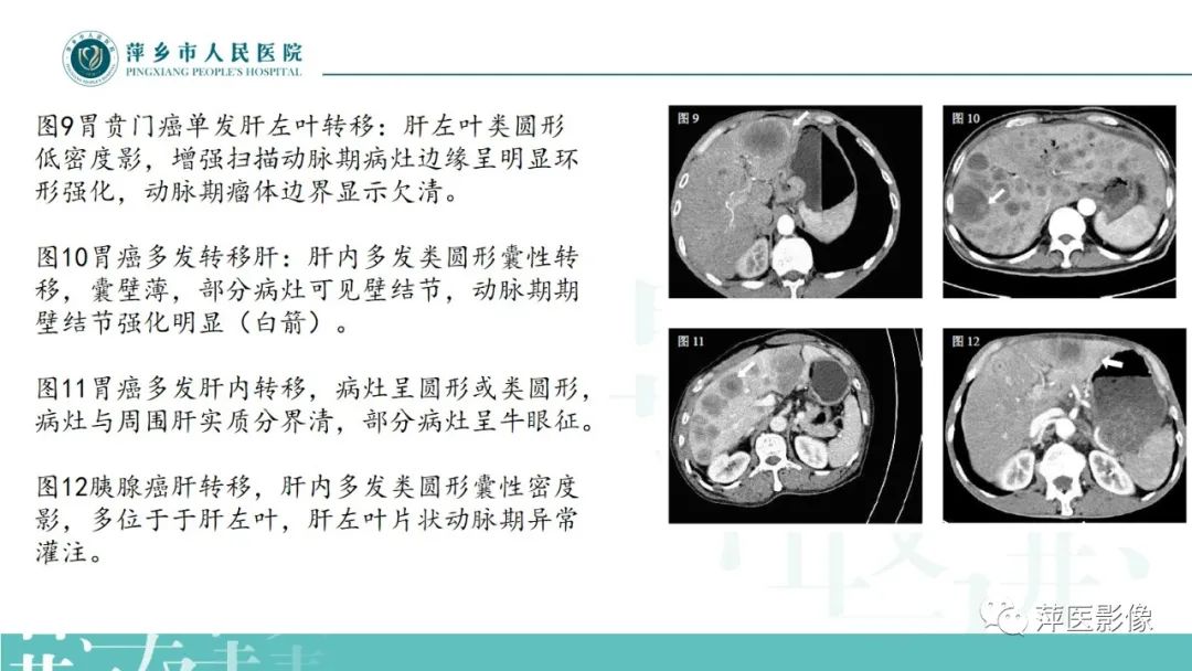 影像PPT - 【PPT】寻根问底—肝转移瘤-30